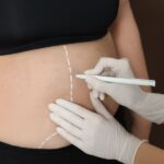 Estetik Cerrahinin Popüler Yöntemleri liposuction (2)