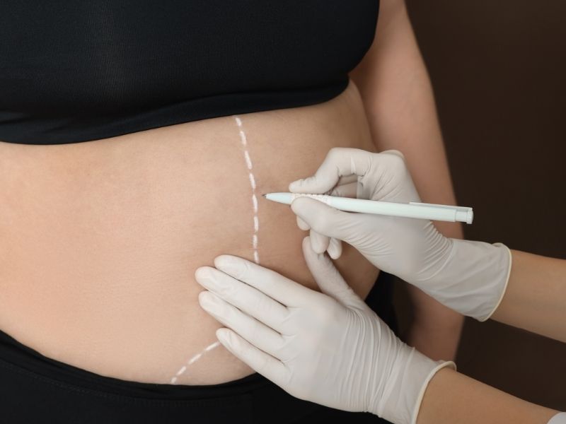 Estetik Cerrahinin Popüler Yöntemleri