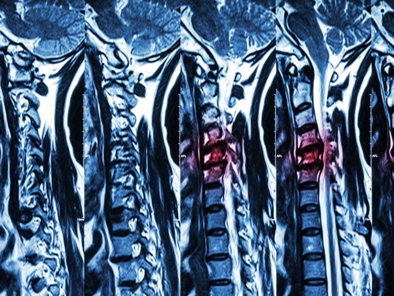 Boyun Fıtığı Ameliyatı Sonrası Ağrılar ve Skolyoz Tedavisi
